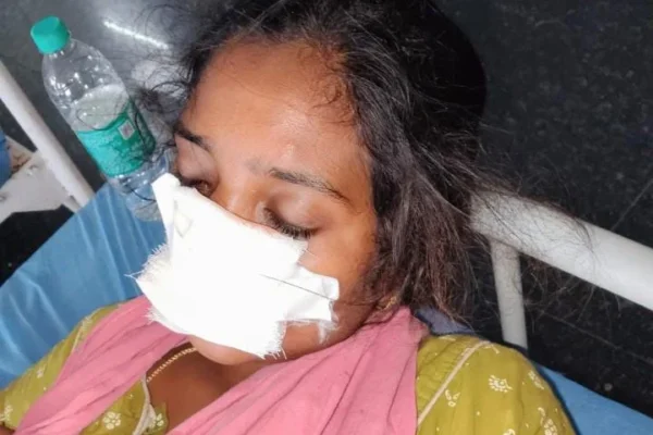 குடும்பம் நடத்த வரமறுத்த மனைவியின் மூக்கை கடித்த கணவன் : மாமனாரும் காயம்