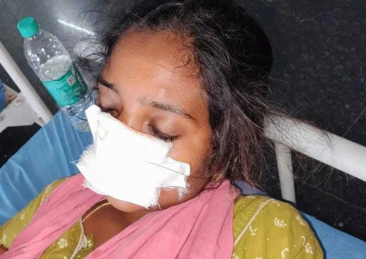 குடும்பம் நடத்த வரமறுத்த மனைவியின் மூக்கை கடித்த கணவன் : மாமனாரும் காயம்